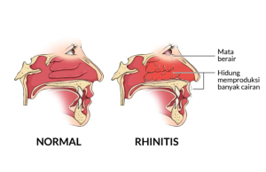 Apakah Penyakit Rhinitis Berbahaya ? Mari Kita Bahas Disini