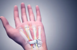 Mengatasi Carpal Tunnel Syndrome (CTS) Solusi untuk Mengurangi Nyeri