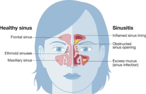 Sinusitis Pengertian, Penyebab, dan Langkah Pengobatannya