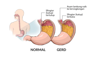Mengenal Gejala Asam Lambung dan GERD Apa Saja yang Perlu Anda Ketahui?